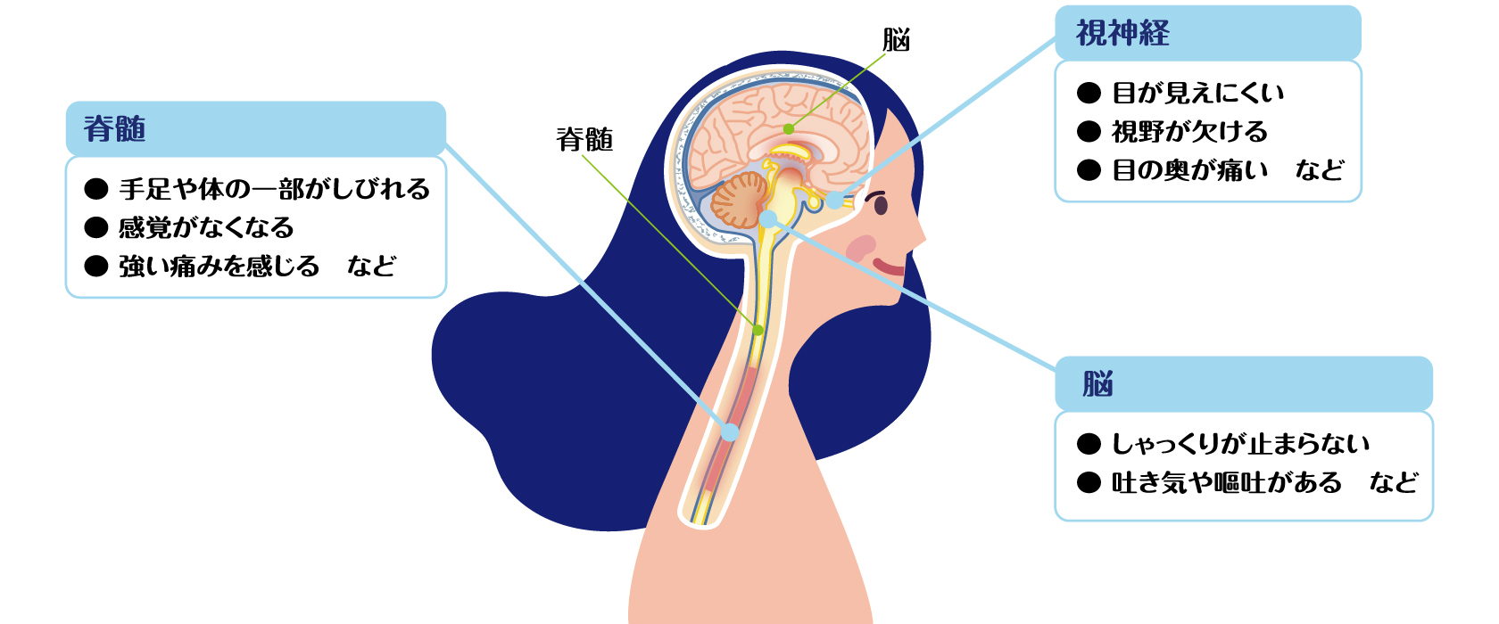 脊髄では、手足や体の一部がしびれる、感覚がなくなる、強い痛みを感じるなど。視神経では、目が見えにくい、視野が部分的に欠ける、目の奥が痛いなど。脳では、しゃっくりが止まらない、吐き気や嘔吐があるなど。
