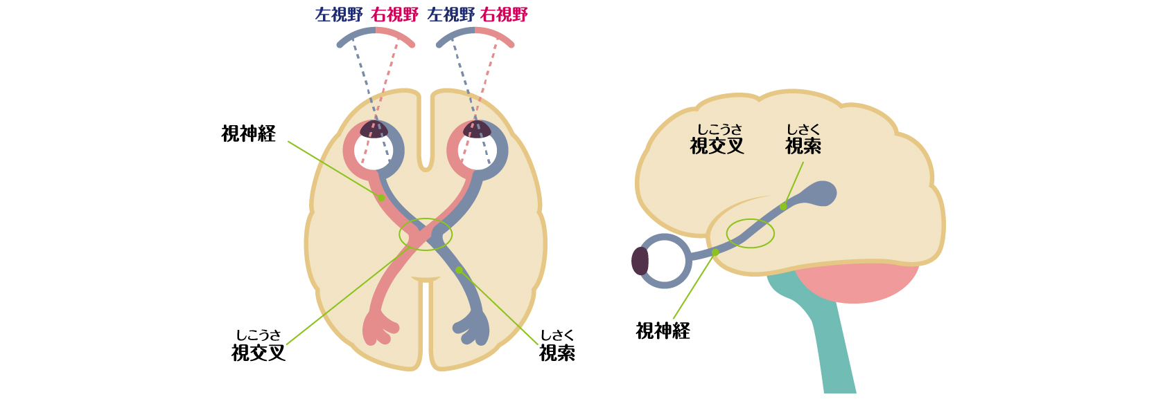 視神経の炎症部位によって、発現する視野異常が異なることを示す図。視索部の炎症では同名性半盲、視交叉の炎症では両耳側半盲がみられる。視神経部分の炎症では、視野異常ではなく炎症側の視力が低下する。