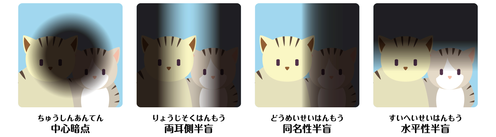 中心暗点（中央部分が見えにくい様子）、両耳側半盲（両側が見えにくい様子）、同名性半盲（右側が見えにくい様子）、水平性半盲（上部が見えにくい様子）を示したイメージ図。