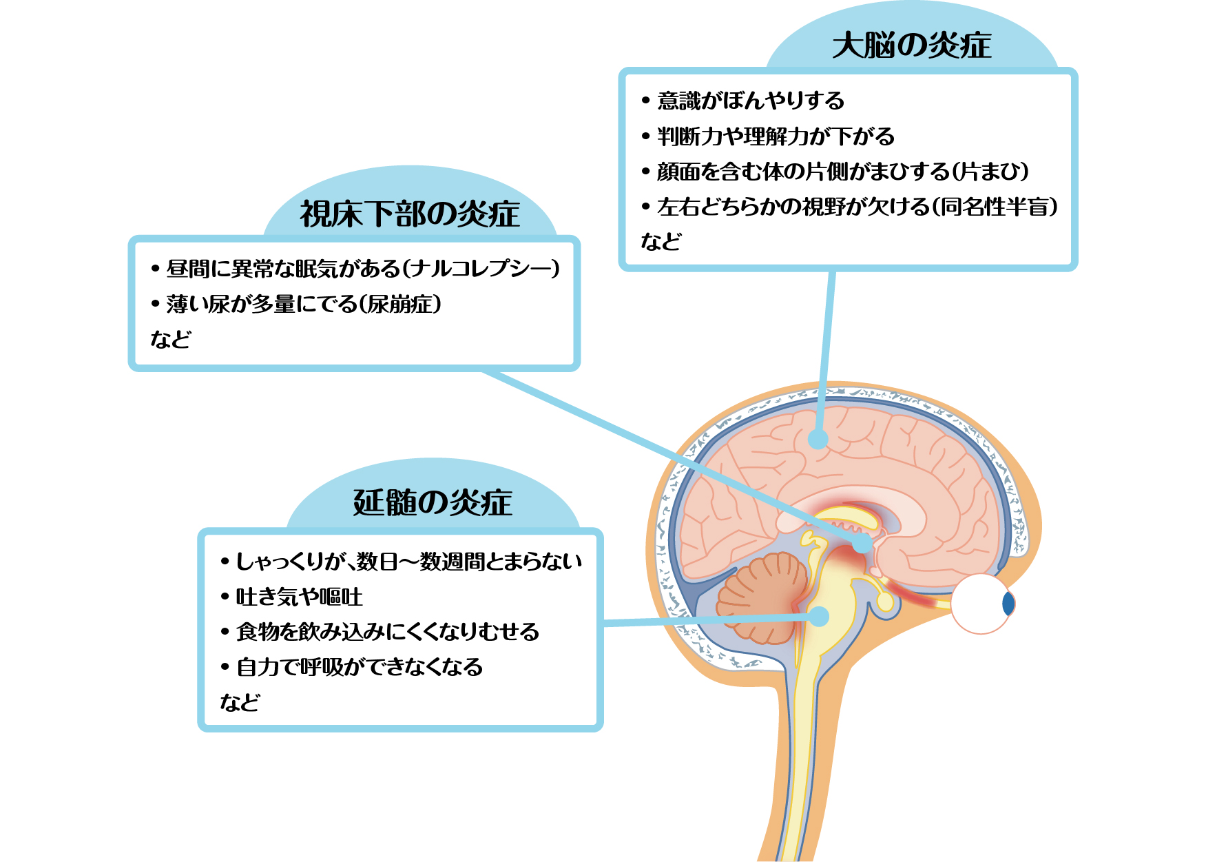 脳の炎症で起こる症状のイメージ図。大脳の炎症では、意識がぼんやりする、判断力や理解力が下がる、顔面を含む体の片側がまひする（片まひ）、左右どちらかの視野が欠ける（同名性半盲）など。視床下部の炎症では、昼間に異常な眠気がある（ナルコレプシー）、薄い尿が多量にでる（尿崩症）など。延髄の炎症では、しゃっくりが、数日～数週間とまらない、吐き気や嘔吐、食物を飲み込みにくくなりむせる、自力で呼吸ができなくなるなど。