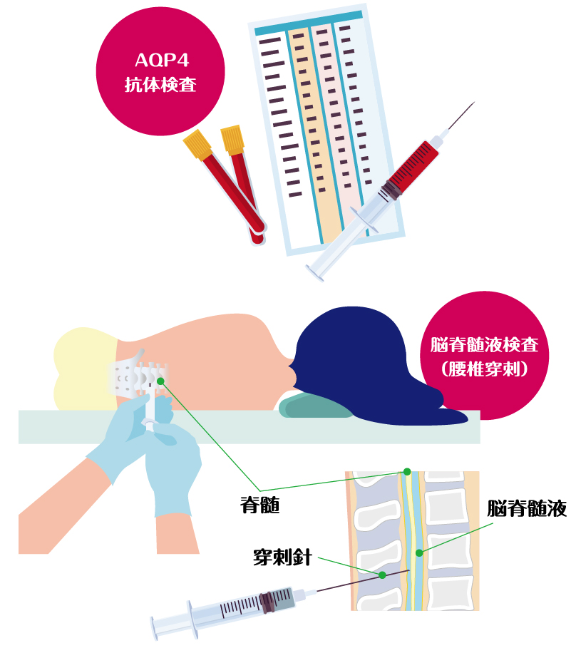 AQP4抗体検査、脳脊髄液検査（腰椎穿刺）のイメージ図。