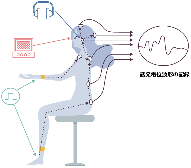 誘発電位検査のイメージ図。