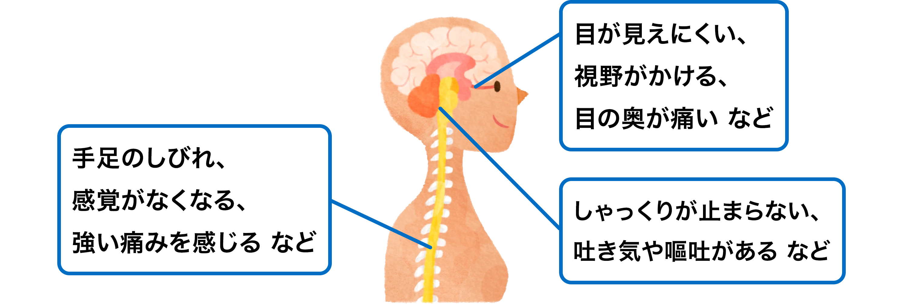 目が見えにくい、視野がかける、目の奥が痛い など（視神経炎症状）、感覚がなくなる、強い痛みを感じる など（脊髄炎症状）、吐き気や嘔吐がある など（脳の症状）